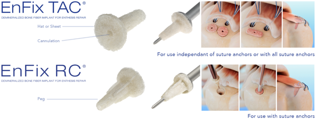 EnFix TAC and RC implants for enthesis repair.