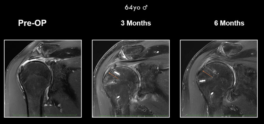 Case study of a 64-year-old patient demonstrating progression enthesis regeneration (arrows) following rotator cuff repair with EnFix.