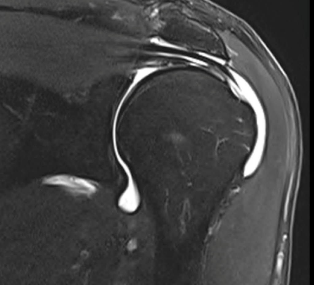 Pre-op - Pre-op and six-month post-op MRI results showing rotator cuff healing with EnFix