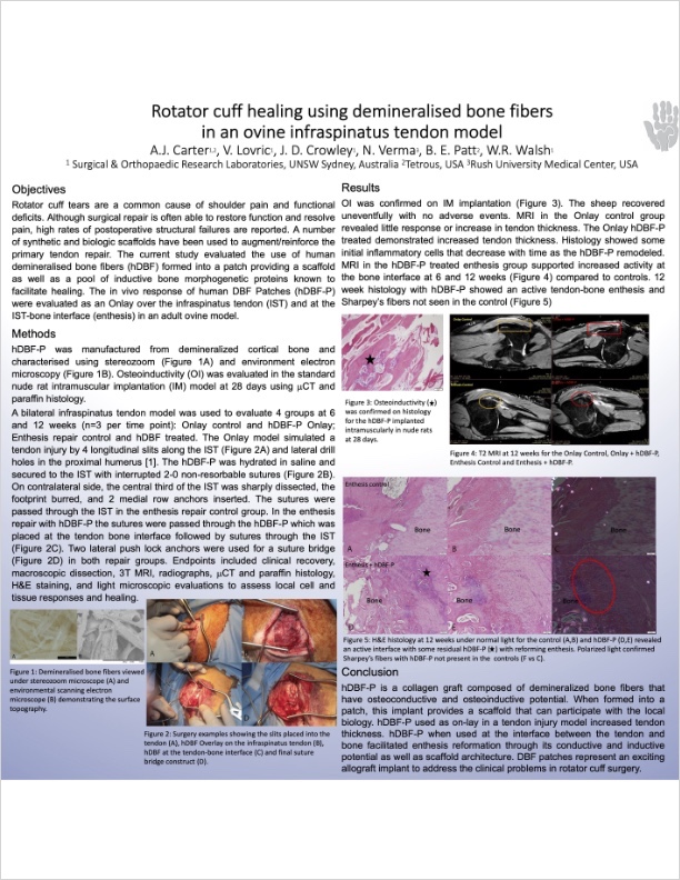 Rotator Cuff Healing Using Demineralised Bone Fibers in an Ovine Infraspinatus Tendon Model