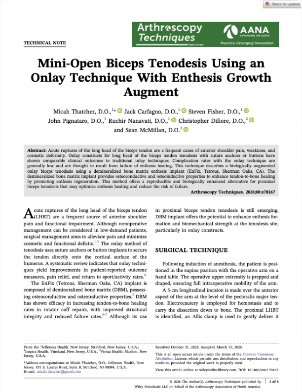 McMillan - Mini-Open Biceps Tenodesis Using an Onlay Technique With Enthesis Growth Augment