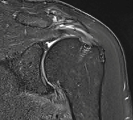 Six-month Post-op - Pre-op and six-month post-op MRI results showing rotator cuff healing with EnFix